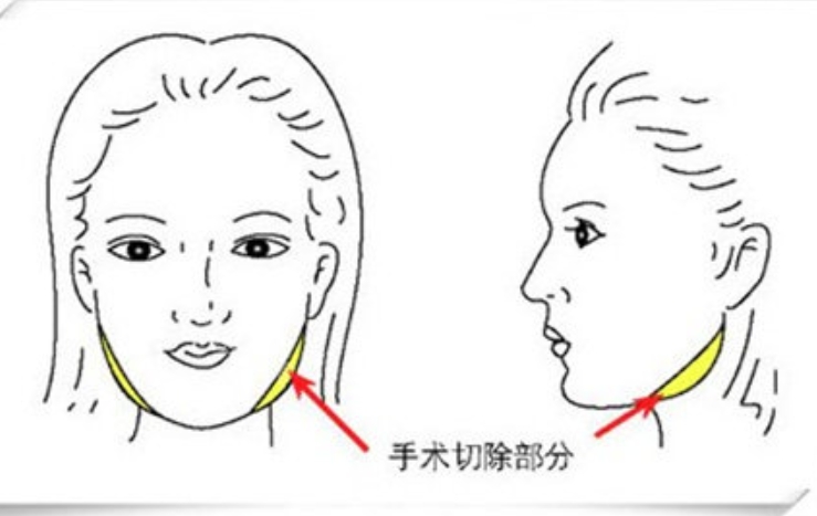 李运峰磨骨价格优势