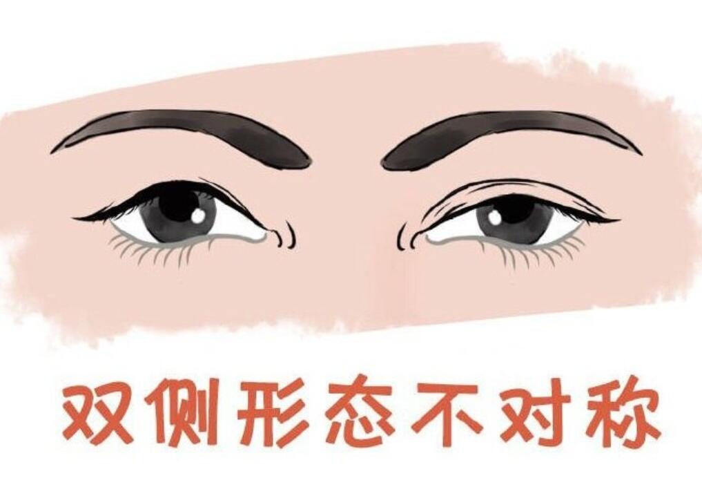 合肥雙眼皮修復(fù)醫(yī)生哪個好