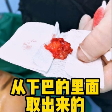 張立彬生長因子取出怎么樣