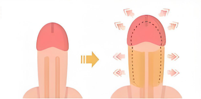 韩国ss男科整形医院阴茎延长术收费标准