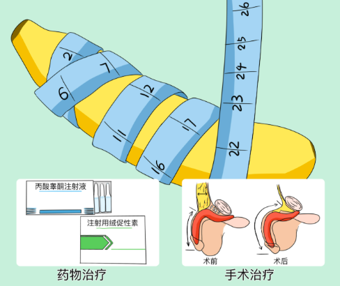 韩国SS男科整形医院阴茎延长增粗成功实例多