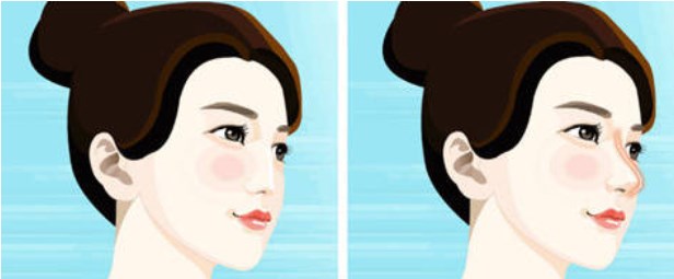 岳伟注射鼻子患者实例