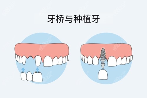 20251104103647.jpg 牙冠桥和种植牙对比图.jpg