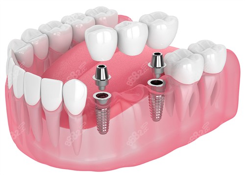 20251104327766.jpg 种植牙的构成.jpg