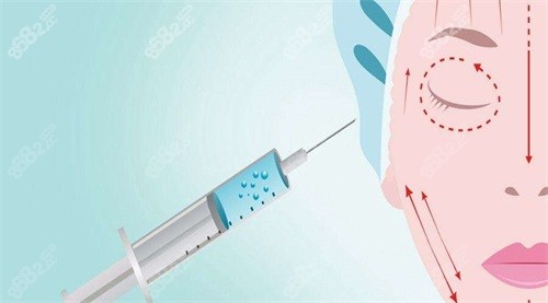 20251104373848.jpg 注射玻尿酸示意圖.jpg