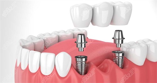 20251104917813.jpg 在口腔内进行种植牙.jpg