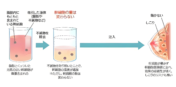 王世虎自体脂肪隆胸的真实感受大公开:三十几年老医生手工吸脂,存活率高达70%是啥感觉?