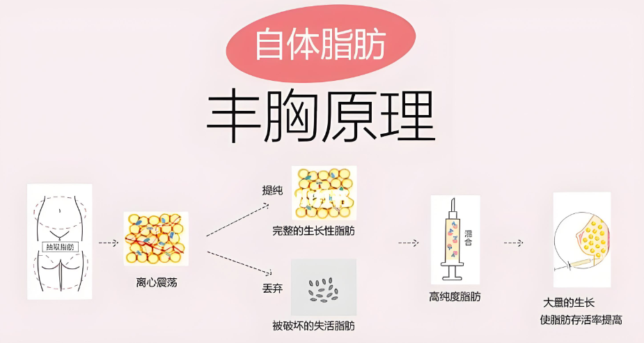 王世虎自体脂肪隆胸原理www.8682.cc