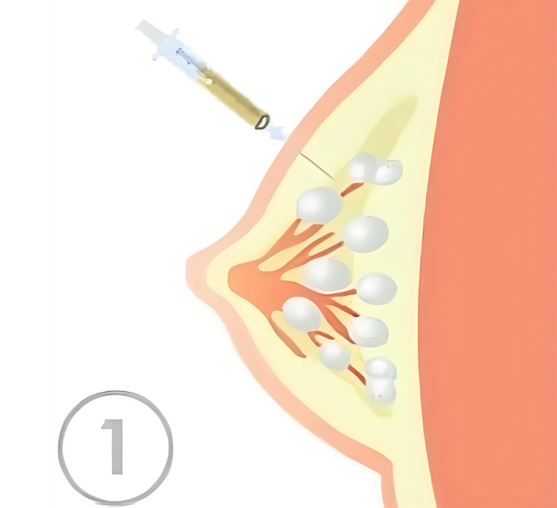 自体脂肪丰胸手术怎么样