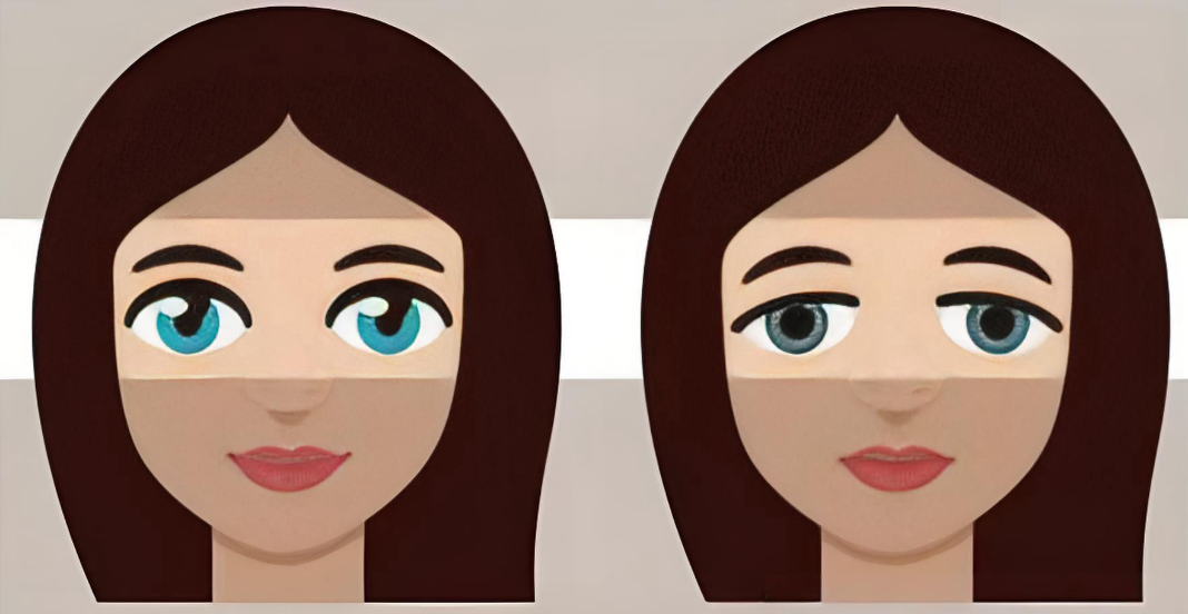 单眼皮显老10岁?北京张菡单眼皮上睑年轻化采用睑缘切口术,30+姐妹7天告别三角眼!