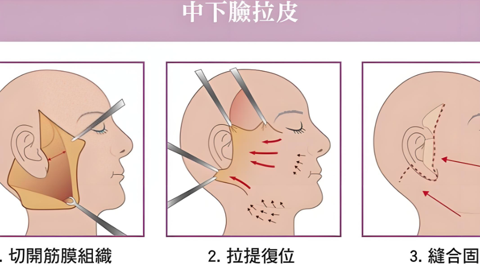 王志军拉皮多久变好？新数据：7-12天复工，三线锚定法让变好期缩短40%！