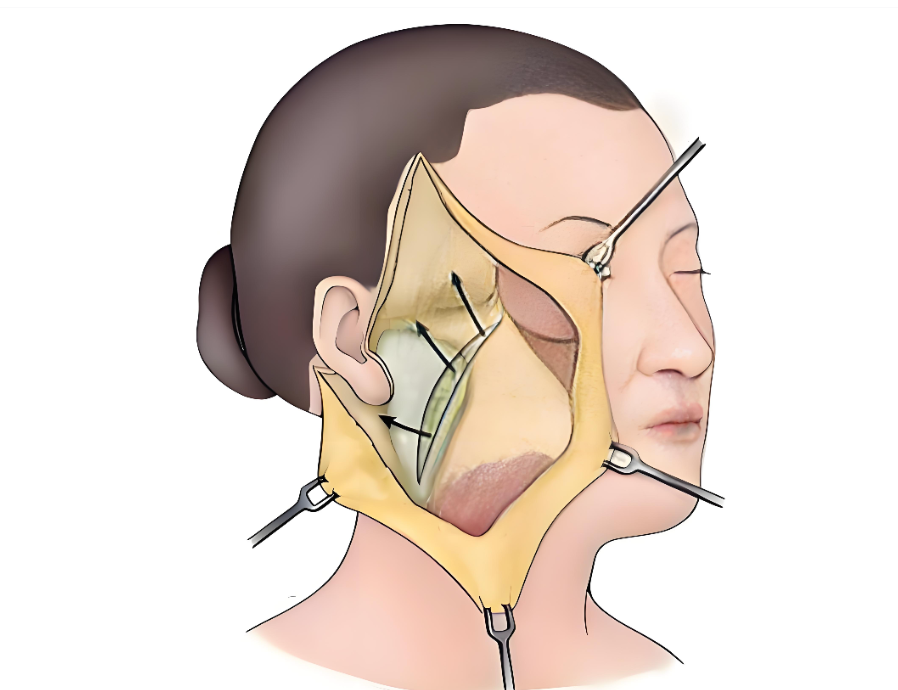 王志军拉皮用的固定材料可吸收吗？医生亲解：可吸收线与不可吸收线这样搭配才靠谱！