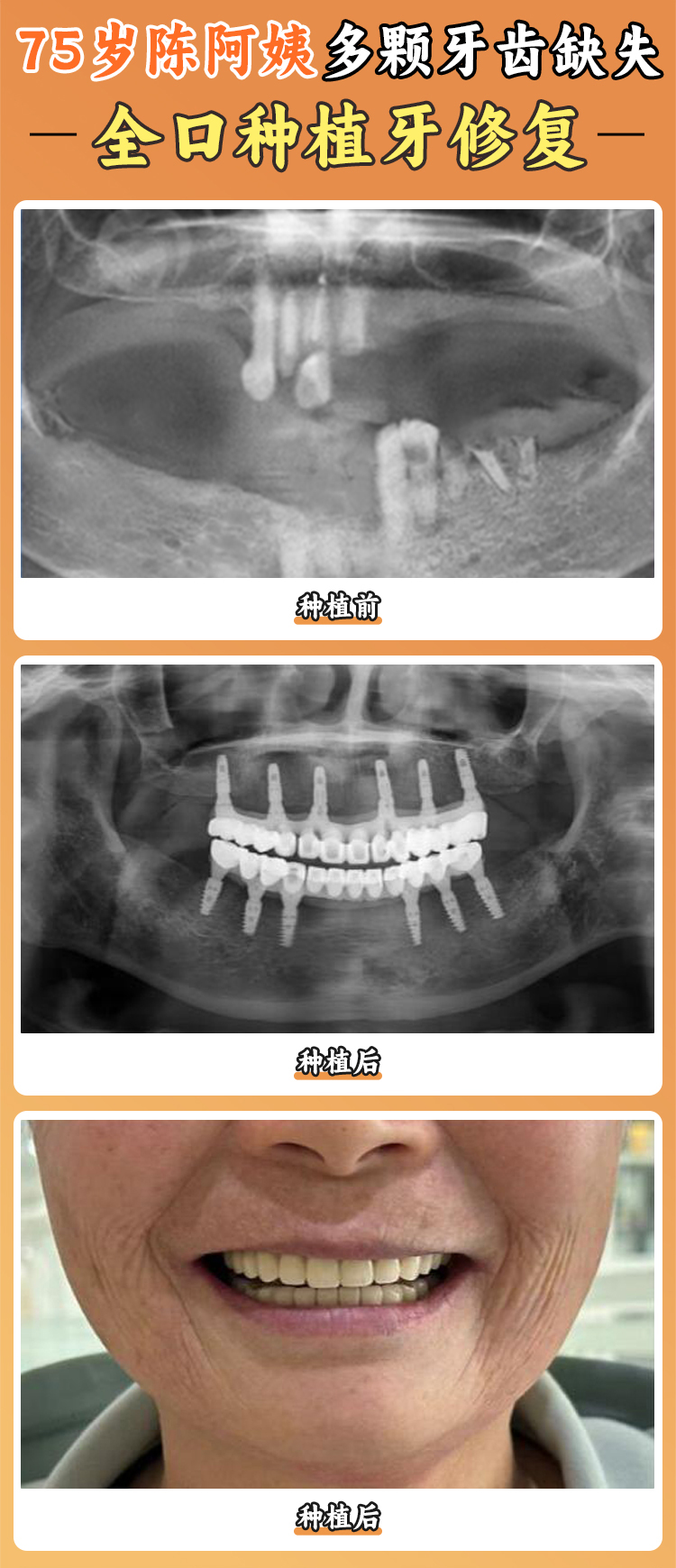 二、寧波好牙引領(lǐng)口腔醫(yī)院種植牙技術(shù)如何？行業(yè)有名氣