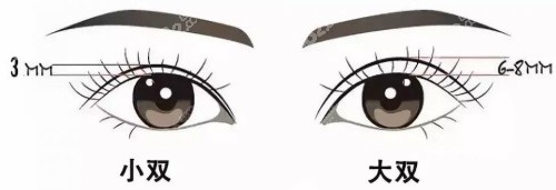 20251105357474.jpg 双眼皮宽度示意图.JPG