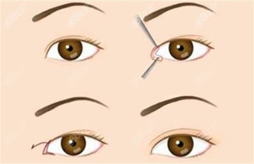 20251105521574.jpg 双眼皮窄改宽修复.jpg