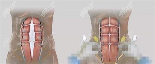 美人魚腹壁成形術(shù)的過程