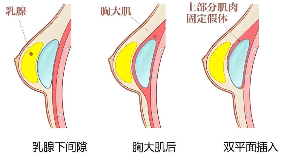 韩国隆胸悬吊手术