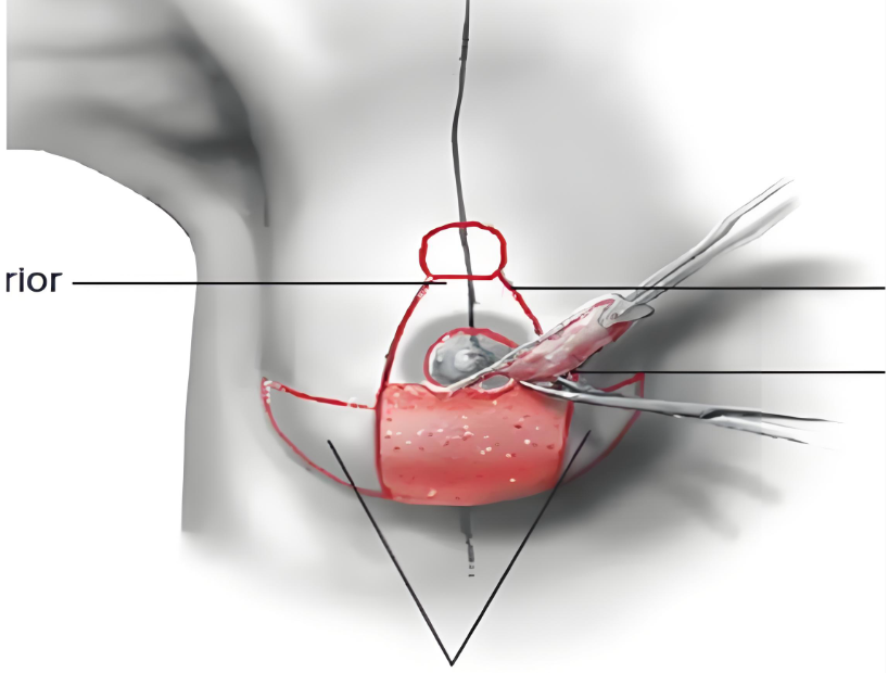 韩国隆胸悬吊手术怎么样