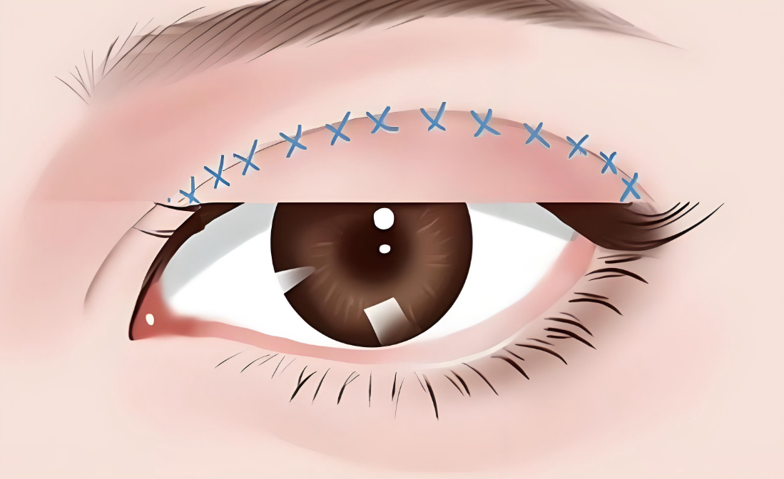 长沙张娇娇医生割双眼皮前后对比:实例看5天拆线1个月消肿的妈生款双眼皮秘诀大公开!