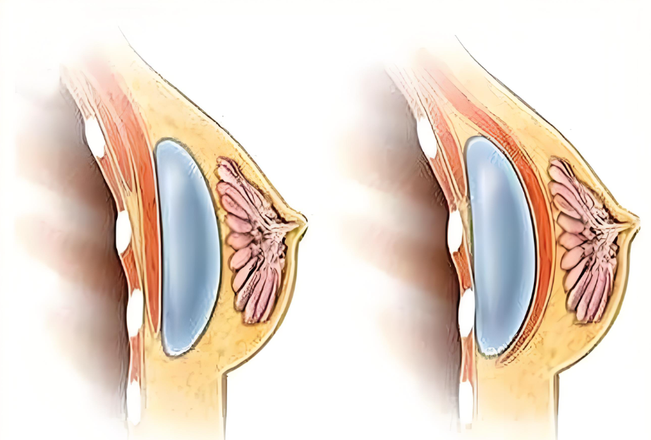 徐国建做胸多少钱www.8682.cc