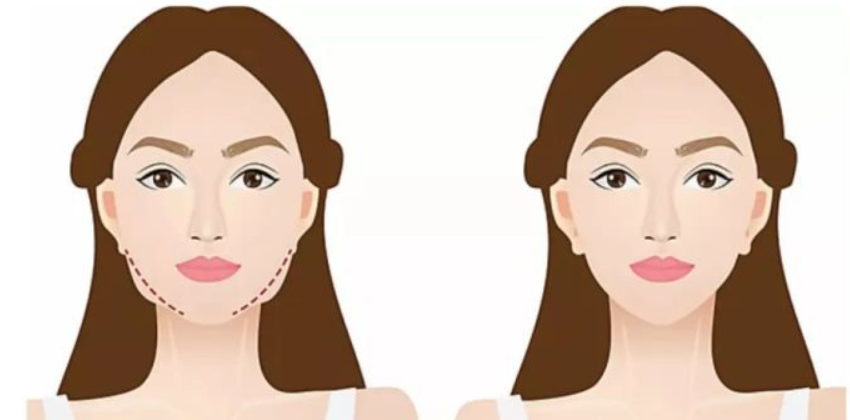 上海磨骨郑康在哪个医院