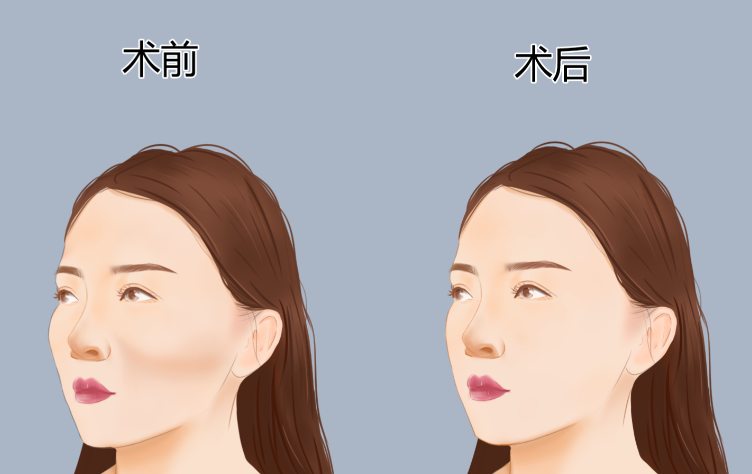 上海磨骨郑康在哪个医院?手术项目及价格参考