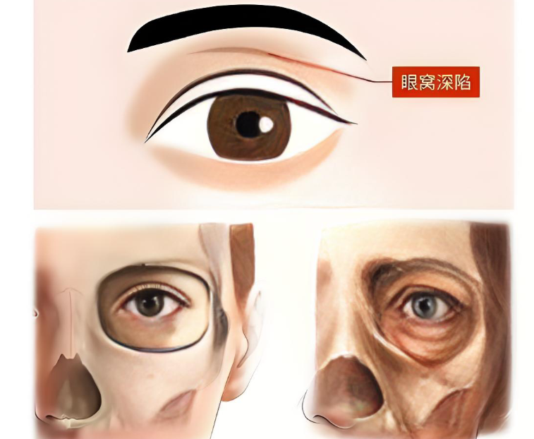 长沙张娇娇做眼窝凹陷手术www.8682.cc