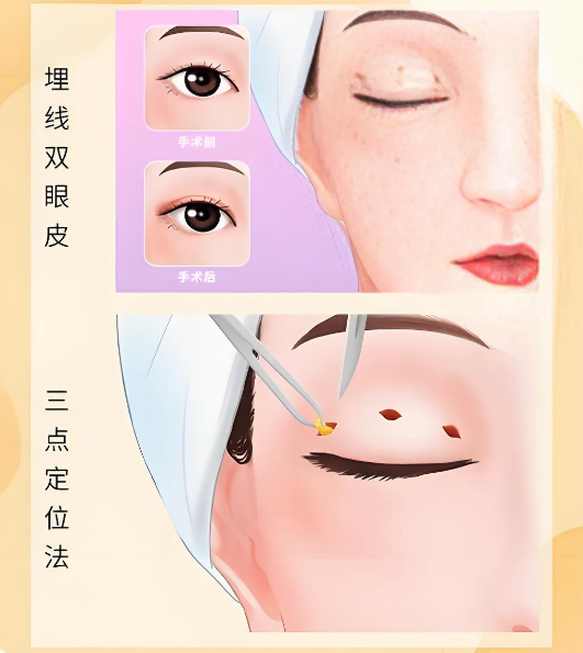 李詹哲双眼皮修复价格