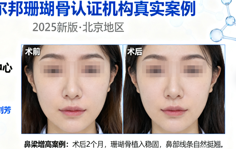 卡洛尔邦珊瑚骨认证医生名单靠谱吗?2025新版广州/北京等10家机构真实案例大公开