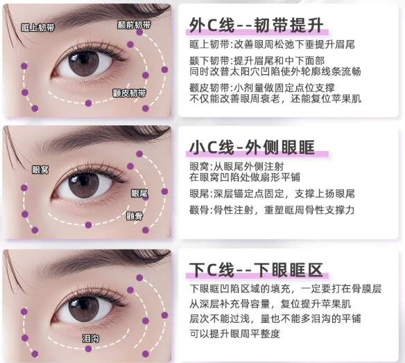 朱维玲眼周筋膜悬吊术后3个月,求美者较关心的变好细节