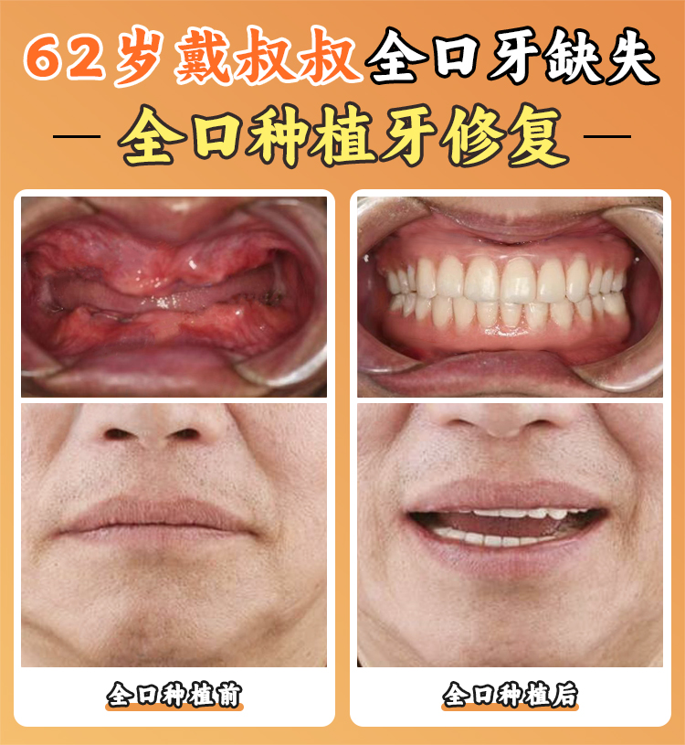 二、西安中诺口腔医院的种植牙技术优势