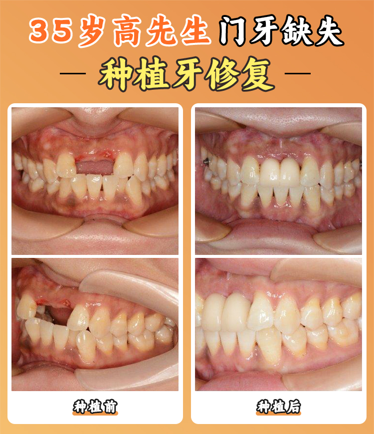 三、西安中诺口腔医院的非凡种植牙医生