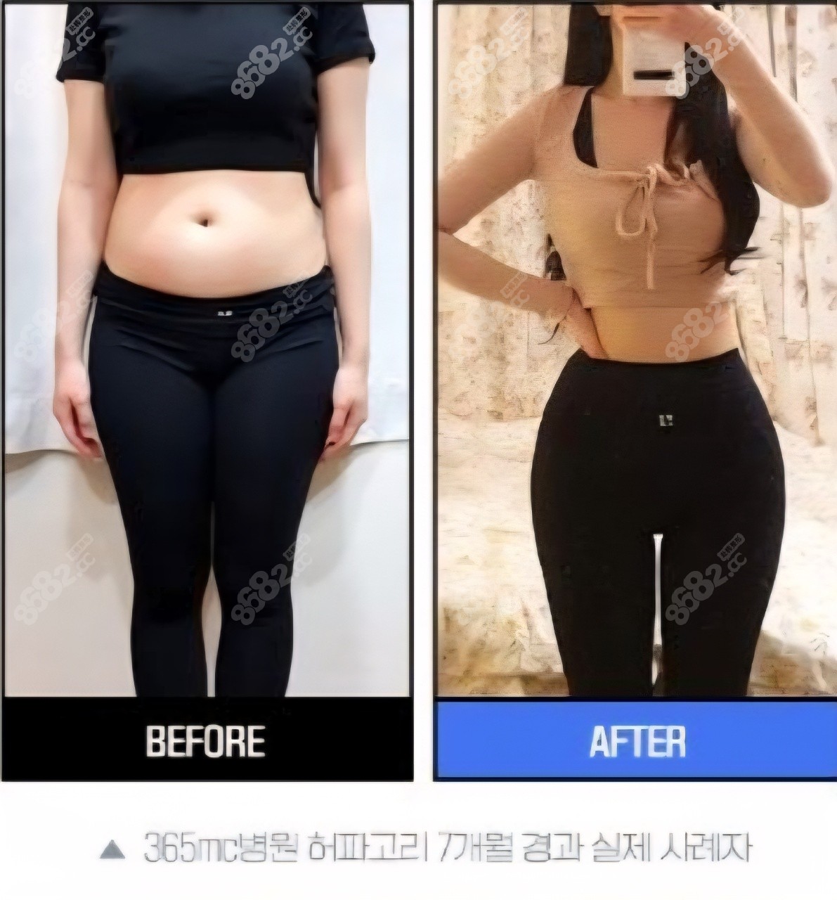 腰腹吸脂 BeautsGO预约 腰腹吸脂 BeautsGO预约