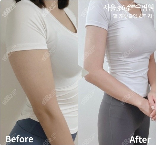 胳膊吸脂 胳膊吸脂