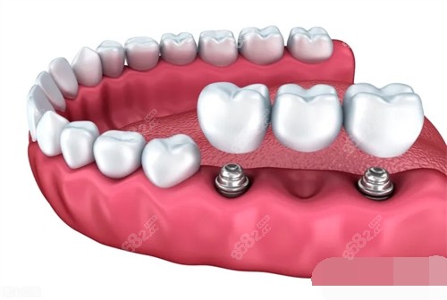 20251106875261.jpg 两颗种植牙安装联排牙冠漫画示意图.jpg