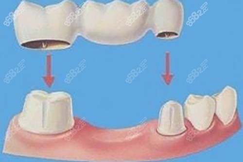 20251106879654.jpg 固定桥示意图.jpg