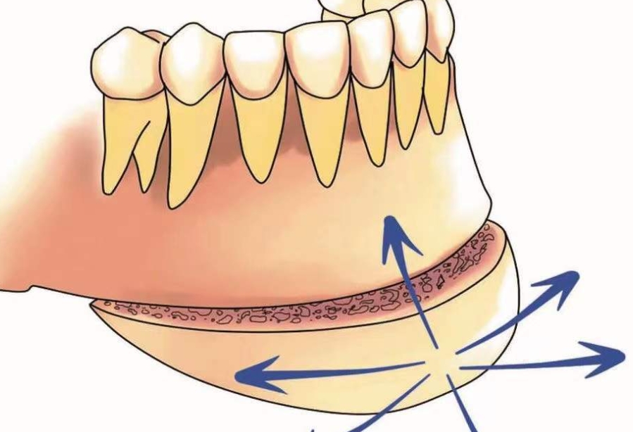 李继华颏成型手术怎么样？复杂病例福音，正颌+颏成型联合修复技术好