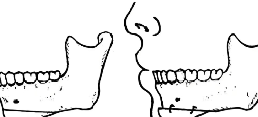 李继华颏成型手术核心优势