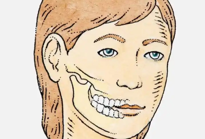 李继华正颌 + 颏成型联合修复技术的突破点