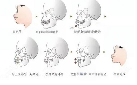 李继华颏成型手术诊疗流程
