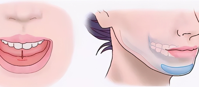 李继华颏成型手术的口碑见证