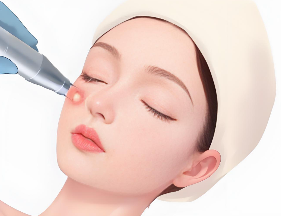 做之前特地问了医生，韩国ONDA提升属于射频类吗？得到的答复是属于单极射频的一种