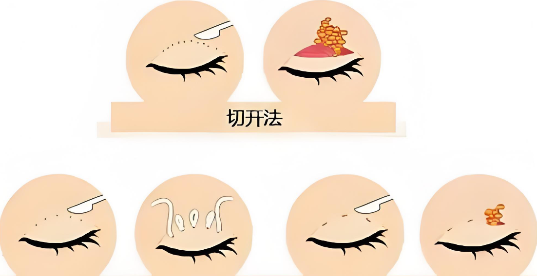 问了好几遍：大连孙璐做双眼皮多少钱？我闺蜜做下来加上药费什么的，总共九千出头