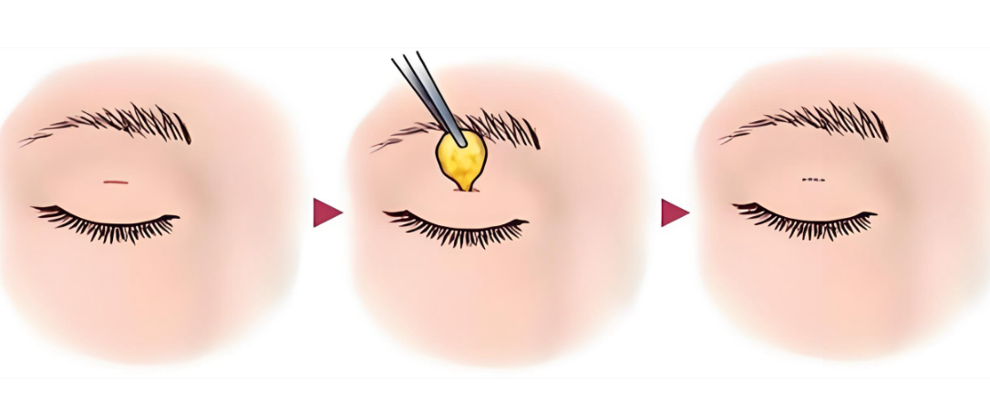 大連孫璐做雙眼皮www.66ub.cn