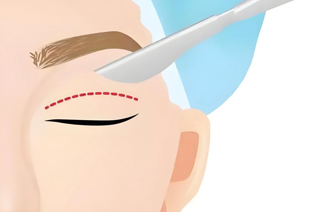 大連孫璐做雙眼皮好不好