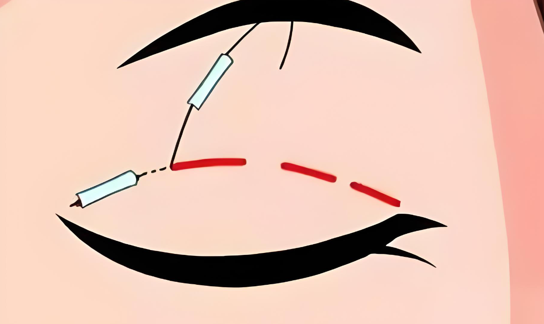 大連孫璐醫(yī)生雙眼皮手術(shù)