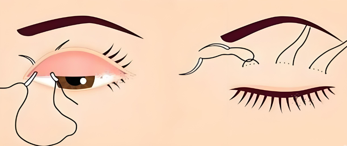 大連孫璐醫(yī)生雙眼皮手術(shù)怎么樣www.66ub.cn