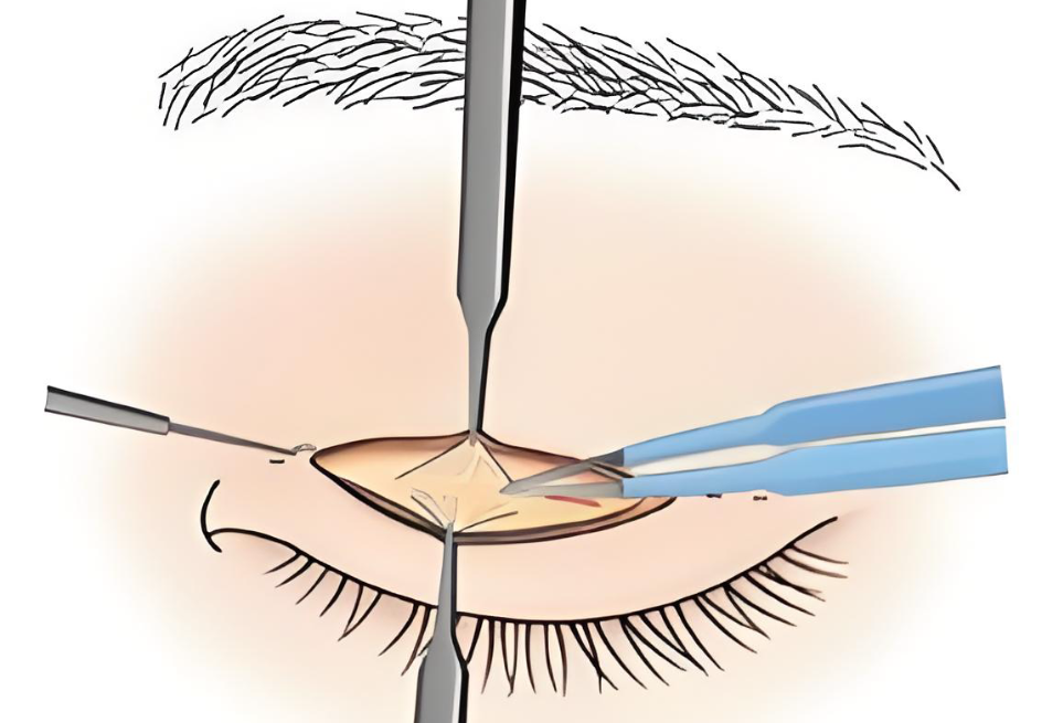 上海呂成醫(yī)生雙眼皮www.66ub.cn