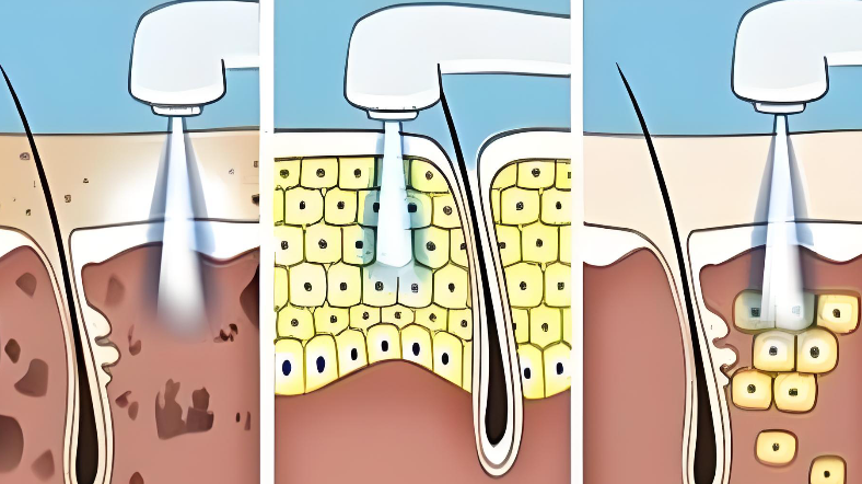 寧波媛藝醫(yī)療超皮秒祛斑優(yōu)勢