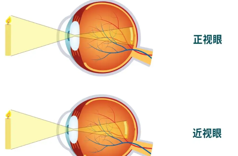 萊蕪明圣眼科預(yù)約電話